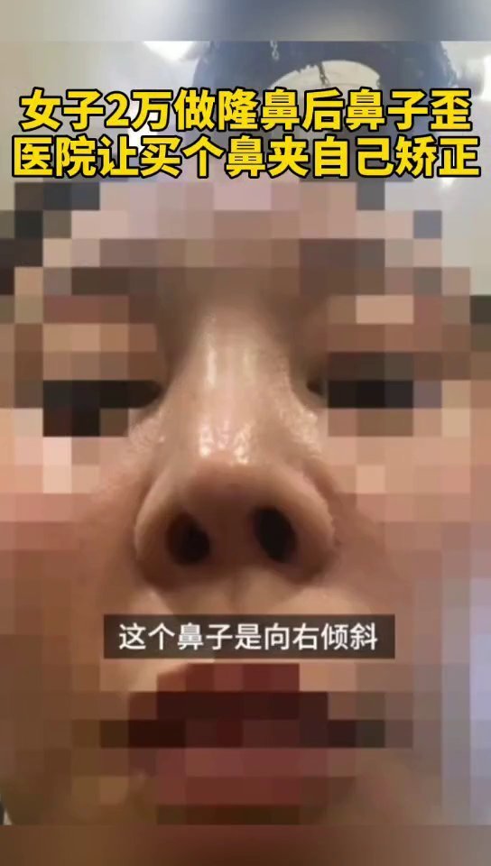 女子花2万隆鼻后鼻子歪了,医院让买个鼻夹自己矫正