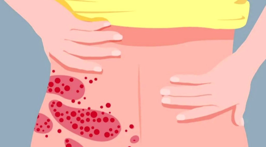 主任医师|蛇盘疮绕一圈就无药可救了?谣言!快来了解这种病