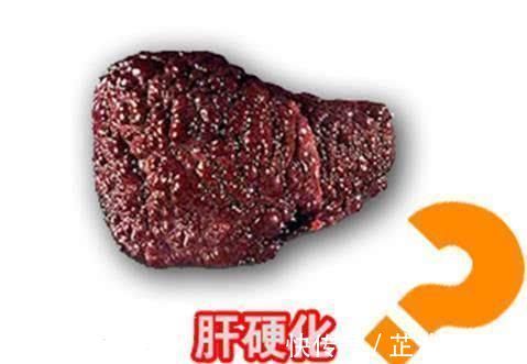 肝硬化|终于找到“肝硬化真凶”,45岁后,想要肝脏不硬,3件事不可少