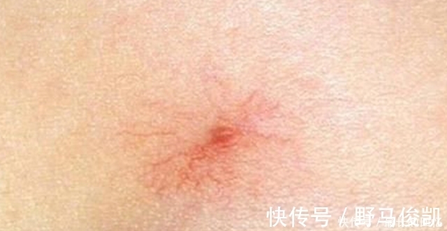 症状|肝病自查，身体频频出现3个症状，小心！你的肝正在受到损伤