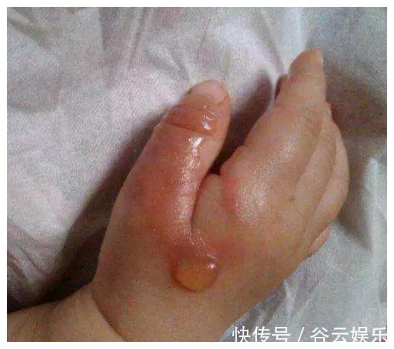 纱布|4岁儿子被开水烫伤,妈妈的“两个果断”救了娃,医生称赞做得对