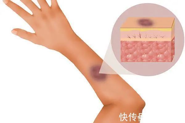 淤青|没磕没碰,为何身上总有淤青?或许与这些原因有关系,别忽视