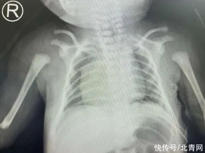 多学科|贵州首例！出生4天的新生儿做这个手术