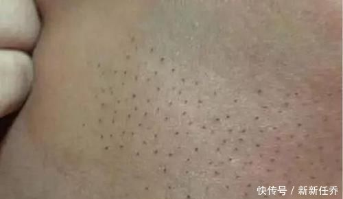 妈妈发现宝宝的背上长满了''黑刺'',把刺一根根拔掉,医生检查后大骂无知