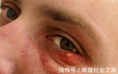 特征|血脂高的人,面部有3个特征,若都没有,血管还算健康