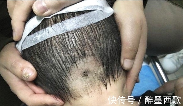 医生|“小血痂”竟然是孩子的夺命虫!医生:幸亏发现的及时
