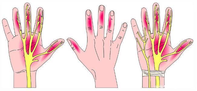  手部麻木的7种常见病因、如何鉴别及治疗