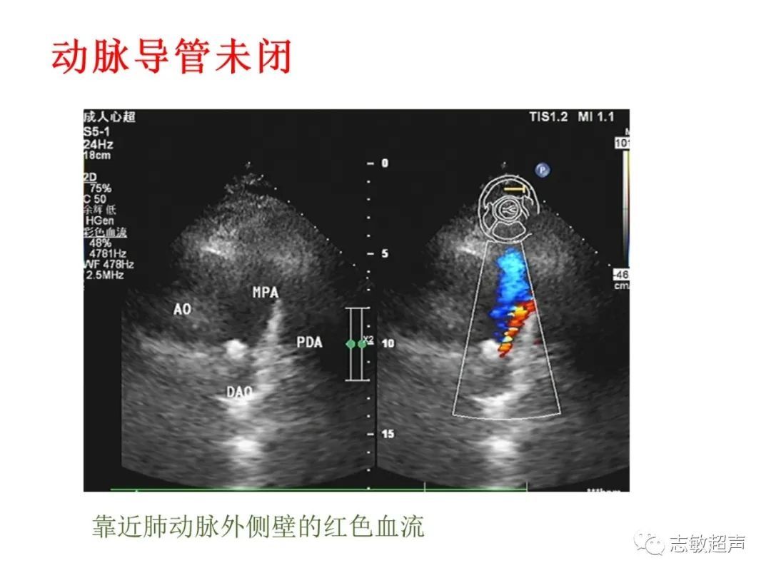 超声|肺动脉瓣周边异常血流的超声鉴别