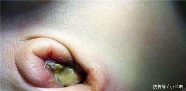 败血症|新手爸妈粗心大意, 宝宝出生不到一个月就得了败血症