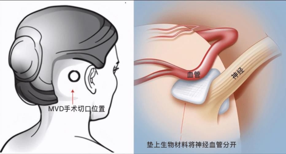 药物|为什么药物无法根治面肌痉挛