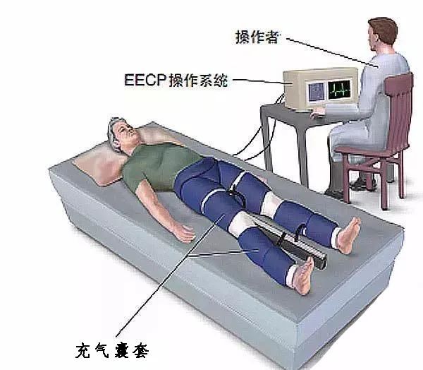 收缩期|潍坊市人民医院专家为您讲解什么是体外反搏？