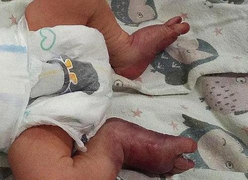 白天生|助产士接生太粗暴,蛮力拽双腿助产,双脚变紫蓝色