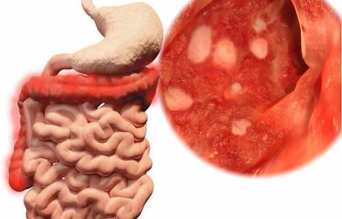  患者|排便若有这5种表现，多半是肠癌发出的求救信号，趁早进行检查