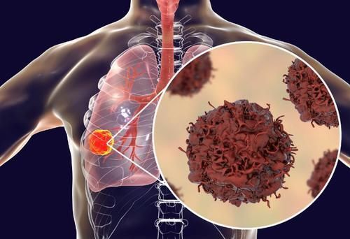 辣椒|肺结节患者不能吃辣椒?医生:要想肺部安稳,3种食物可多吃
