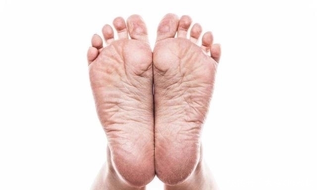 脚跟|“脚后跟干裂”是什么原因导致的?你遇到过这种情况吗?别忽视!