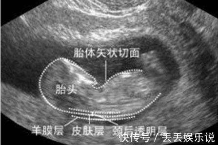 排畸|不想生个“傻儿子”,孕期有三项检查不可少,准妈咪别不当回事