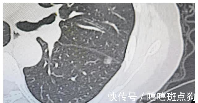 结节|磨玻璃肺癌都是高分化腺癌吗？磨玻璃结节发展到哪种腺癌都有可能