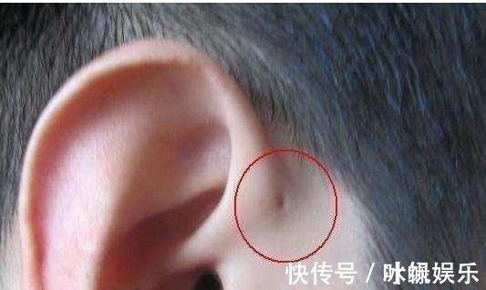 分泌物|儿子的耳朵上有个小洞宝妈试图挤压,导致孩子昏迷,被送到医院