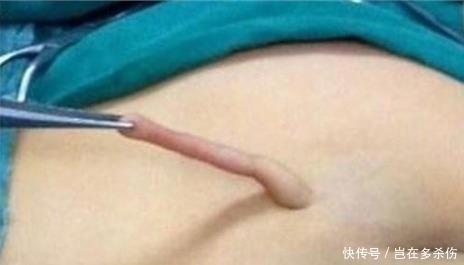 怀孕|新生宝宝竟然长了条小尾巴, 原来是妈妈怀孕时少吃了这个!