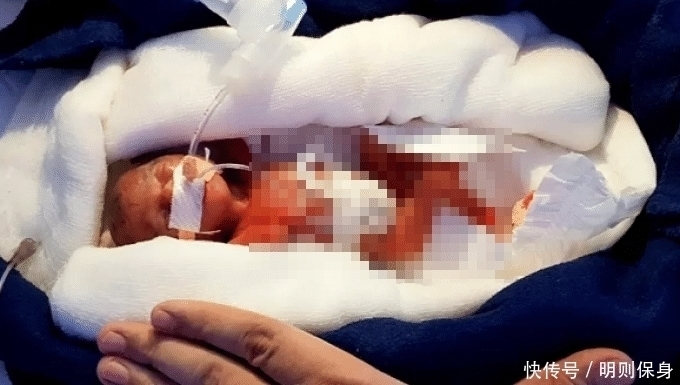 孕妇|全球最小“婴儿”体重245克，比手掌还小，6个月过去了现状如何？