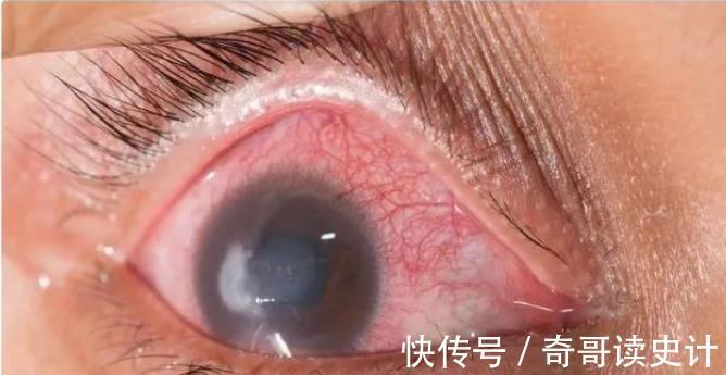 血脂|高血脂“帮凶”已找到，脸上有这3异常，多半血脂已超标，早就医