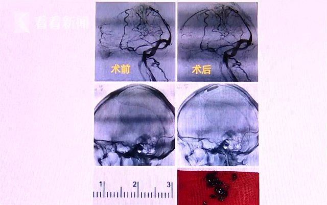 静脉窦|男子奶茶当水喝住进ICU 医生：颅内血管堵了