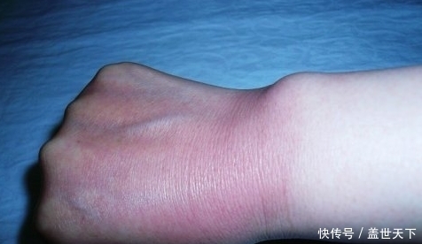 葡萄糖|血糖自测:若“手上”没有3个“信号”,恭喜你,血糖还算稳定