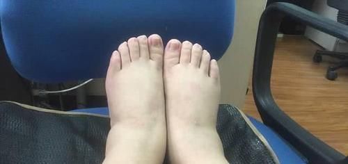  尿毒症的“元凶”已经被找到，“三高”饮食在列，第一个经常忽视