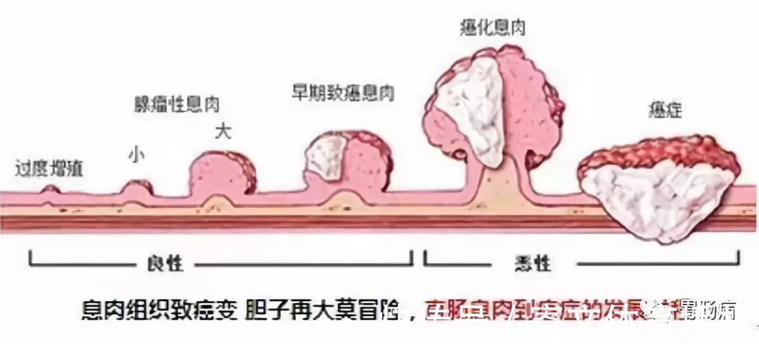 艾灸|大家好!我叫“息肉”,癌症的近亲!我最怕无情又温柔的手术刀：艾灸