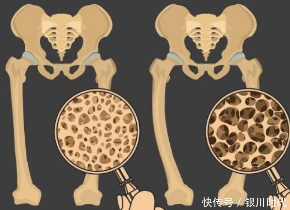 骨质疏松“偏爱”6类人，需特别关注骨骼健康，看看你是否在其中