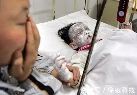 宝妈|4岁男孩意外跌进170度油锅,妈妈一招救了孩子,医生称赞很专业