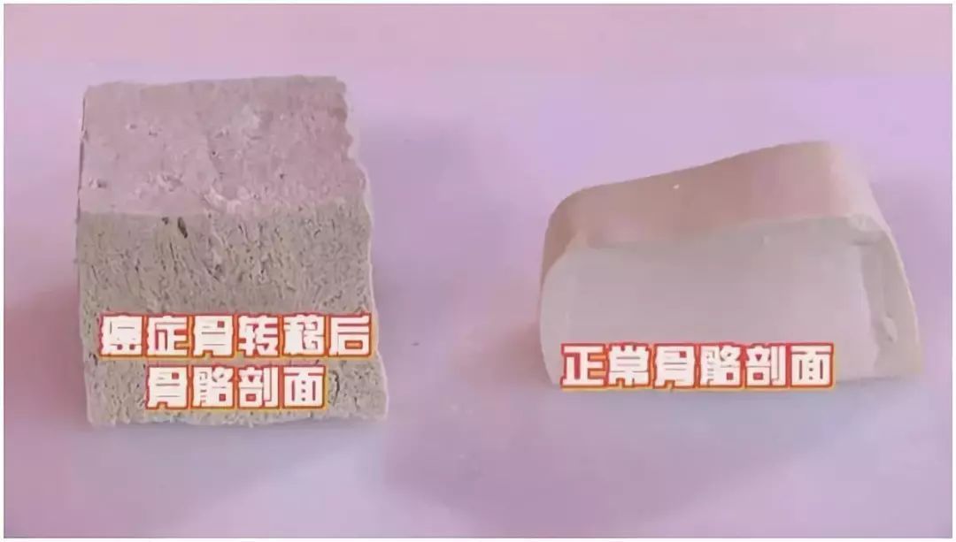 癌细胞|手指长这样,可能是肺癌的早期征兆,1个动作轻松自测!护肺用好这4招~