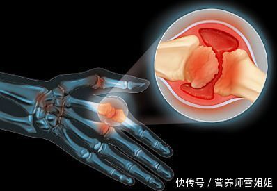  发病|冬季，痛风高发，这4类人，一旦出现3个症状，尿酸高的可怕了