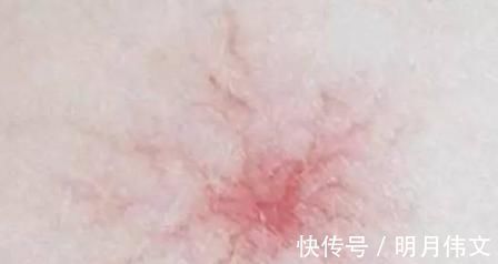 发红|身体2个地方发红、2个地方出血,糟糕:肝硬化“上身”了,勿忽视