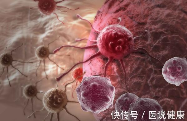 患者|肺癌来报到时,身体这3个处,会有明显的疼痛感,别大意