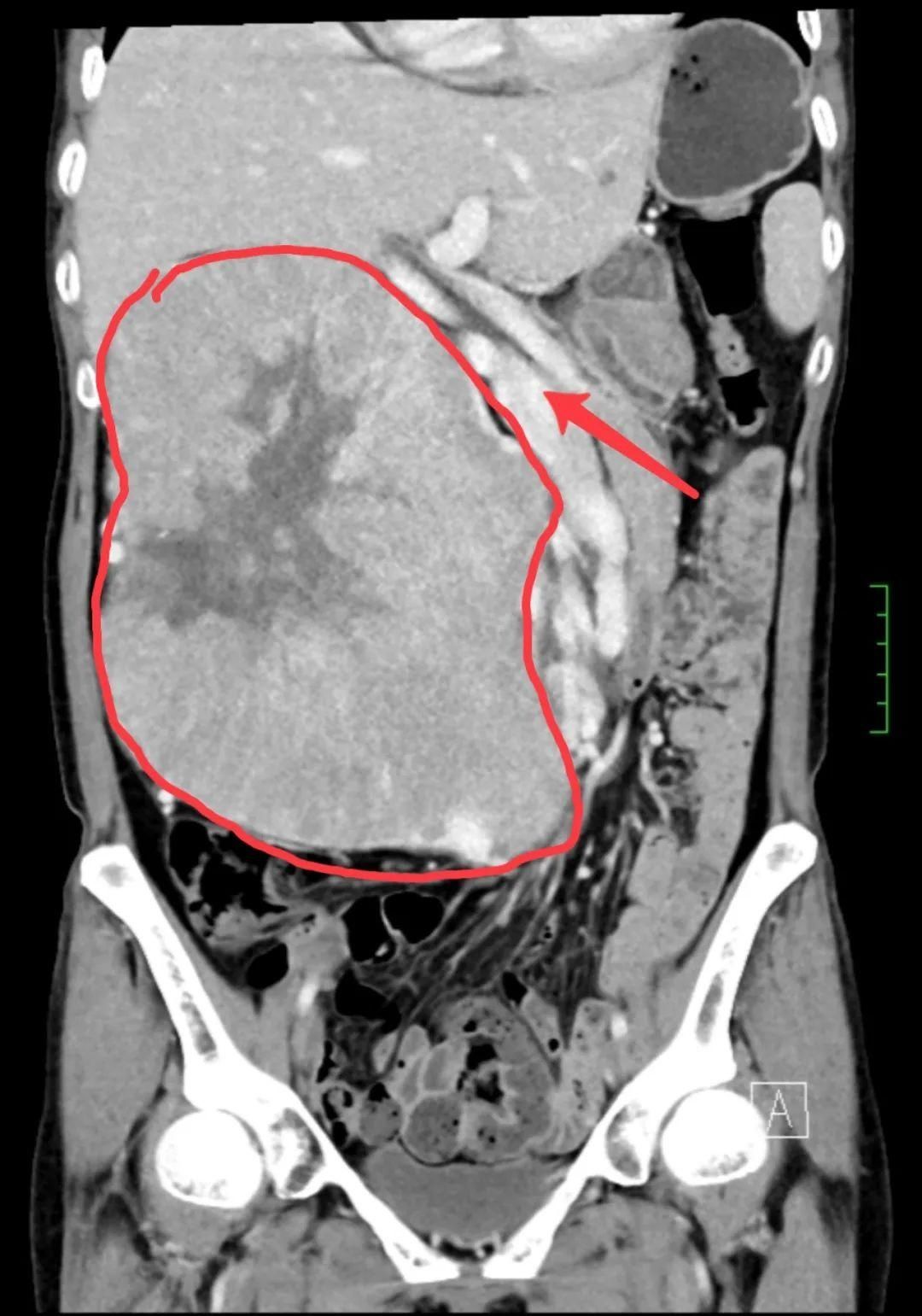 五旬女子“怀胎”10年“生下”西瓜大肿瘤,不换血管摘瘤省了五六万