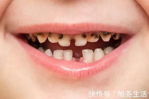 蛀牙|牙科医生提醒:5类零食是孩子蛀牙的根源,孩子再馋也别吃