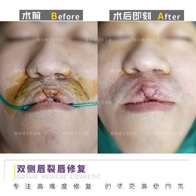 容貌|【案例分享】中年男子也在意相貌?唇裂男子为改善容貌做唇红修复手术