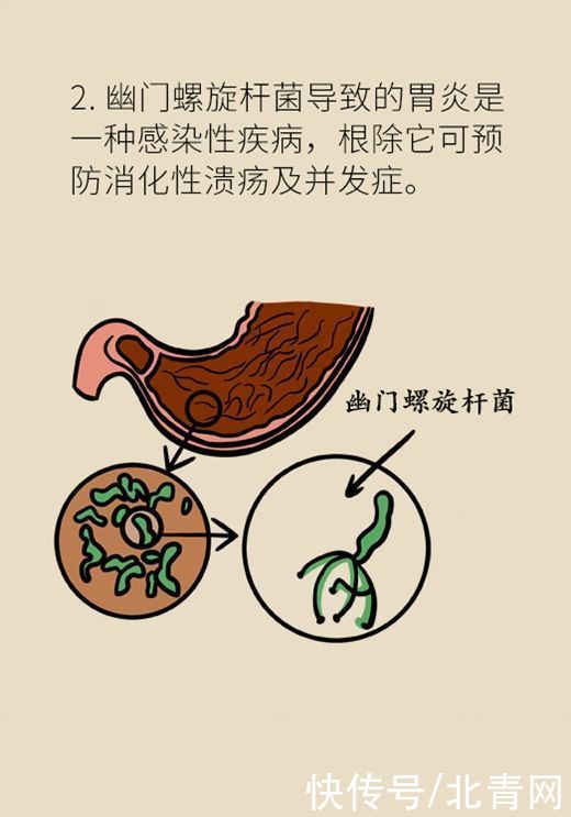 治病|杀菌就是治病？重新认识幽门螺旋杆菌和胃癌的关系