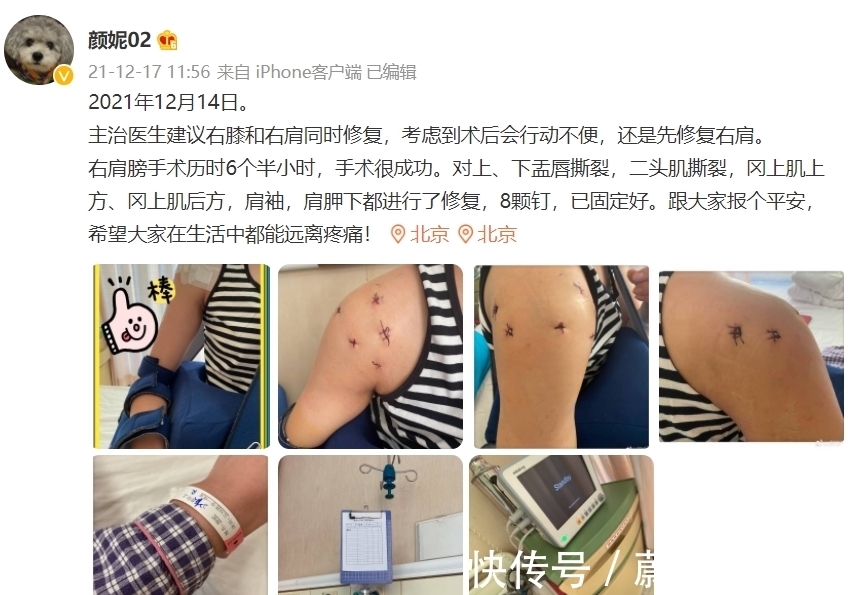 中国女排|女排34岁奥运冠军退役就去医院，右肩打入8颗钢钉照片，不忍直视