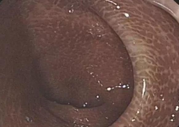 用药|长期吃泻药只为改善便秘？医生提醒：小心1种疾病找上门！