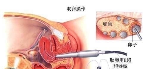 培养箱|揭秘试管婴儿全过程(附图),看完后心疼女性一万遍