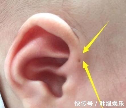 分泌物|儿子的耳朵上有个小洞宝妈试图挤压,导致孩子昏迷,被送到医院