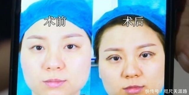 整形医院|花7万2做完双眼皮手术后,眼睛都睁不开了院长你就装吧
