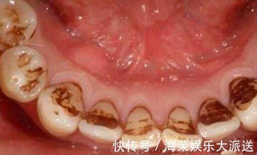 罪魁祸首|妈妈每天偷懒三分钟,3岁女娃竟满口“黑牙”,罪魁祸首不是糖果