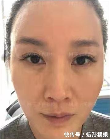 教授 拉皮除皱王小民教授:46岁的她选择了小拉皮手术,看看效果反馈!