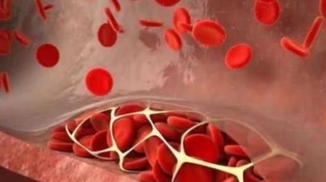 血栓形成|“血栓”是如何形成的？出现血栓不用怕，做好4事，可远离血栓