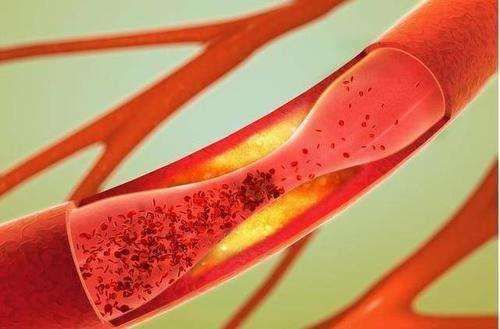 泡脚方|老寒腿、静脉曲张，胀痛、发酸，1个泡脚方直达病处，温通经脉