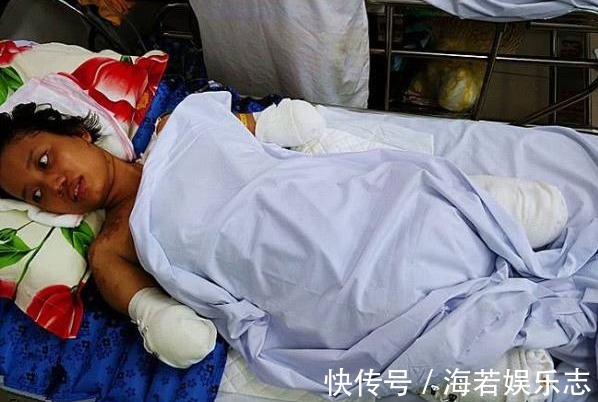 产妇|女子分娩1个月后被截去四肢,医生称是哺乳不当造成的