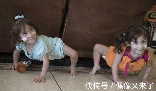 双胞胎姐妹|连体双胞胎姐妹成功分离,不仅没死亡还很健康,只是都少了一条腿